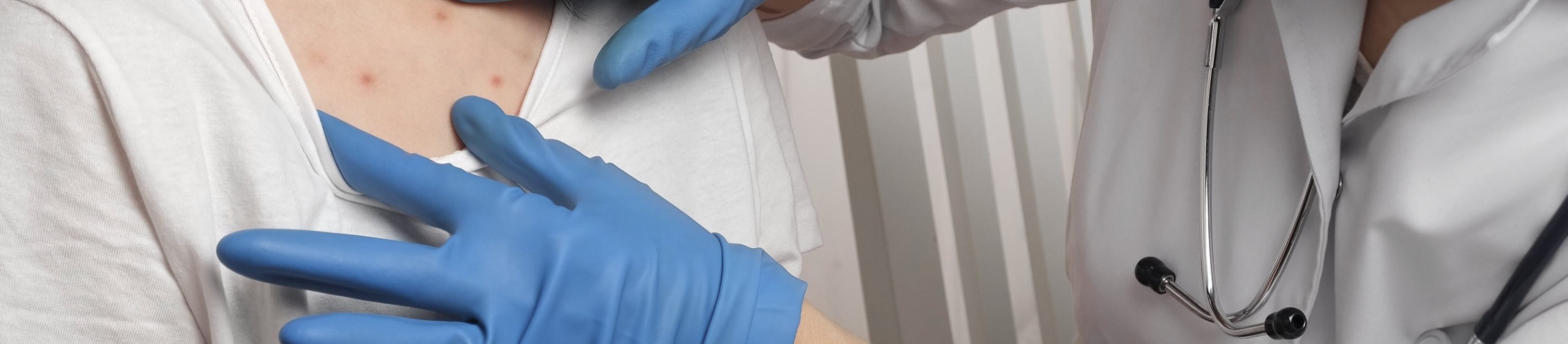 ผื่นแดงโควิด