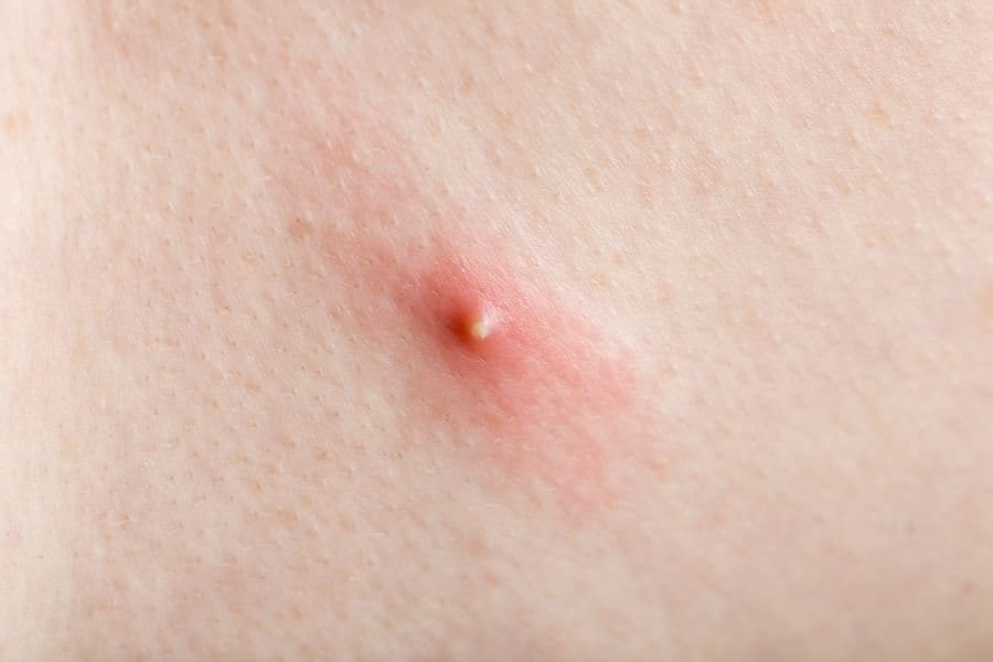 สิวหัวหนอง