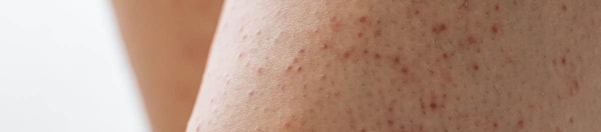 ตุ่มขึ้นตามตัว คล้ายสิว คัน