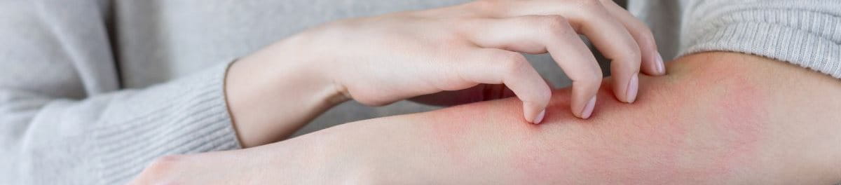 ตุ่มแดงตามตัว,ผื่นแดง ไม่คัน,จุดแดงขึ้นตามตัว