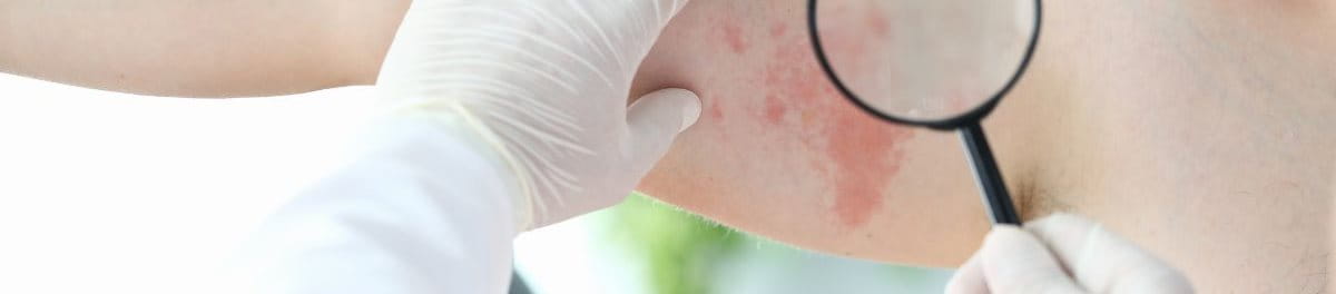 โรคผิวหนังอักเสบจากเชื้อรา