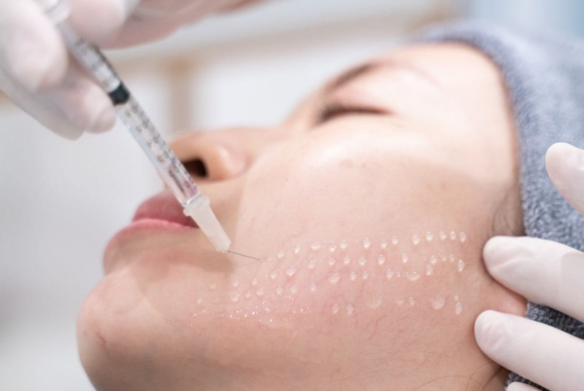 ฉีดเมโส