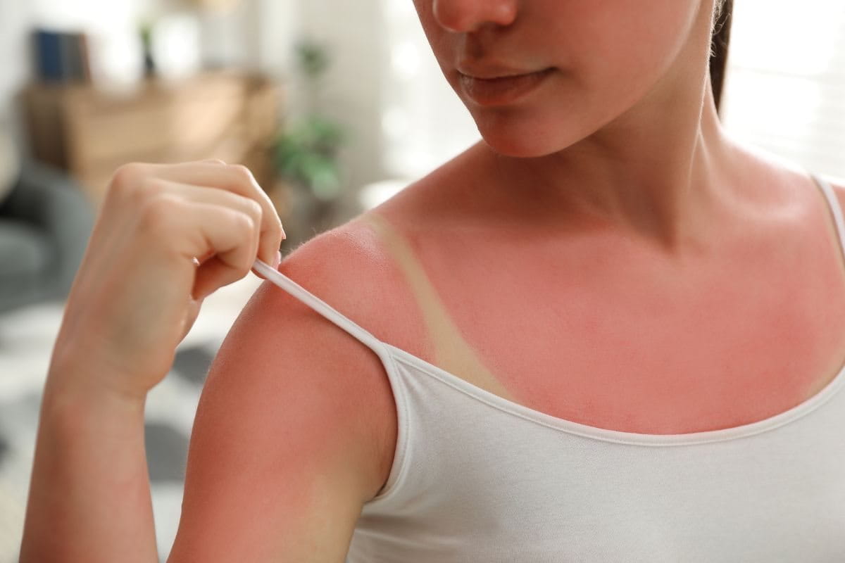 ผิวไหม้แดด