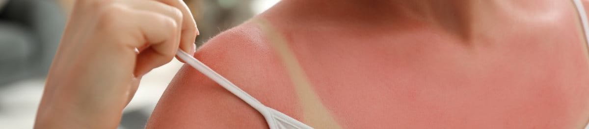 ผิวไหม้แดด