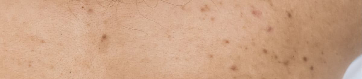 รอยสิวที่หลัง