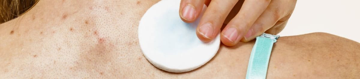 เป็น สิว ที่ หลัง ใช้ อะไร หาย