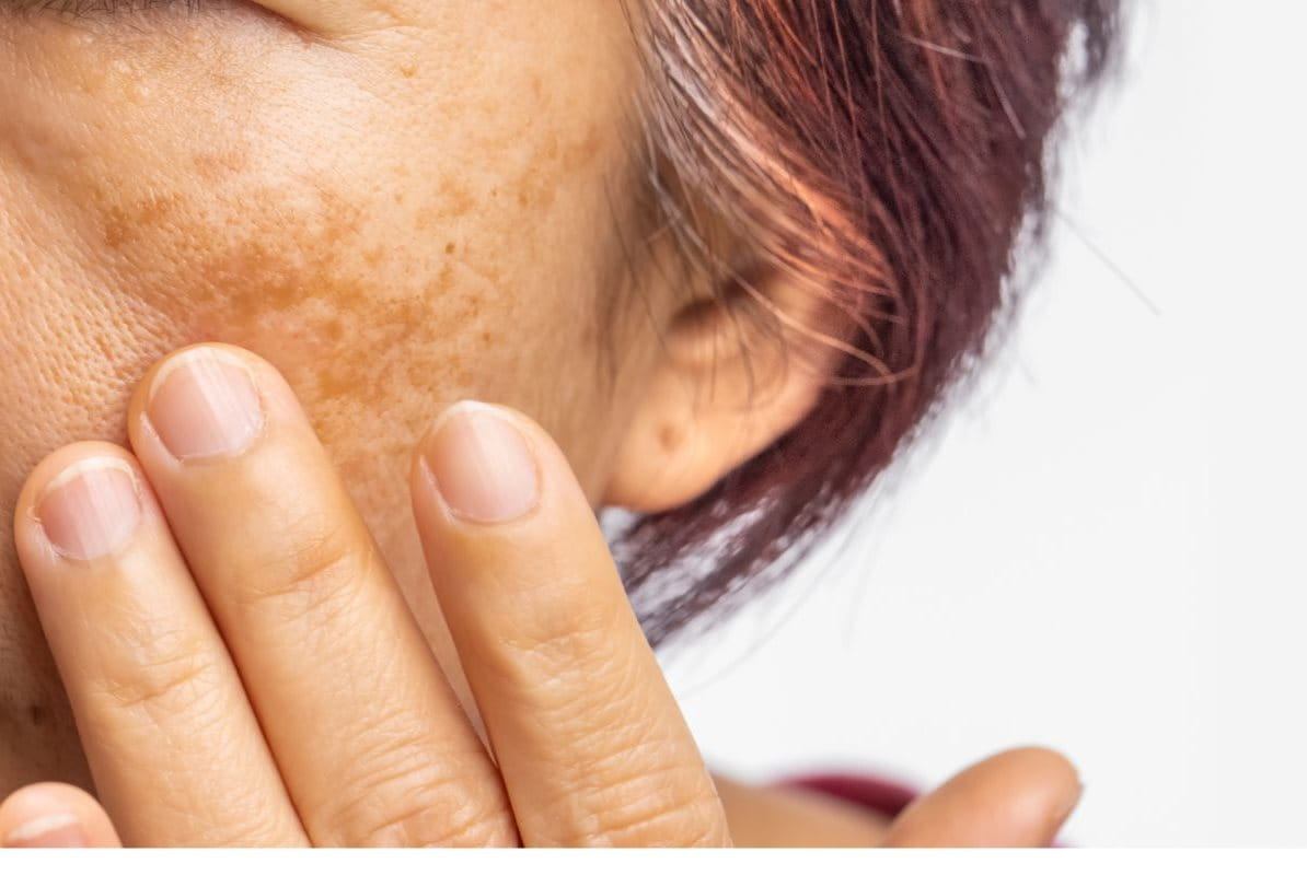 ฝ้าตรงโหนกแก้ม