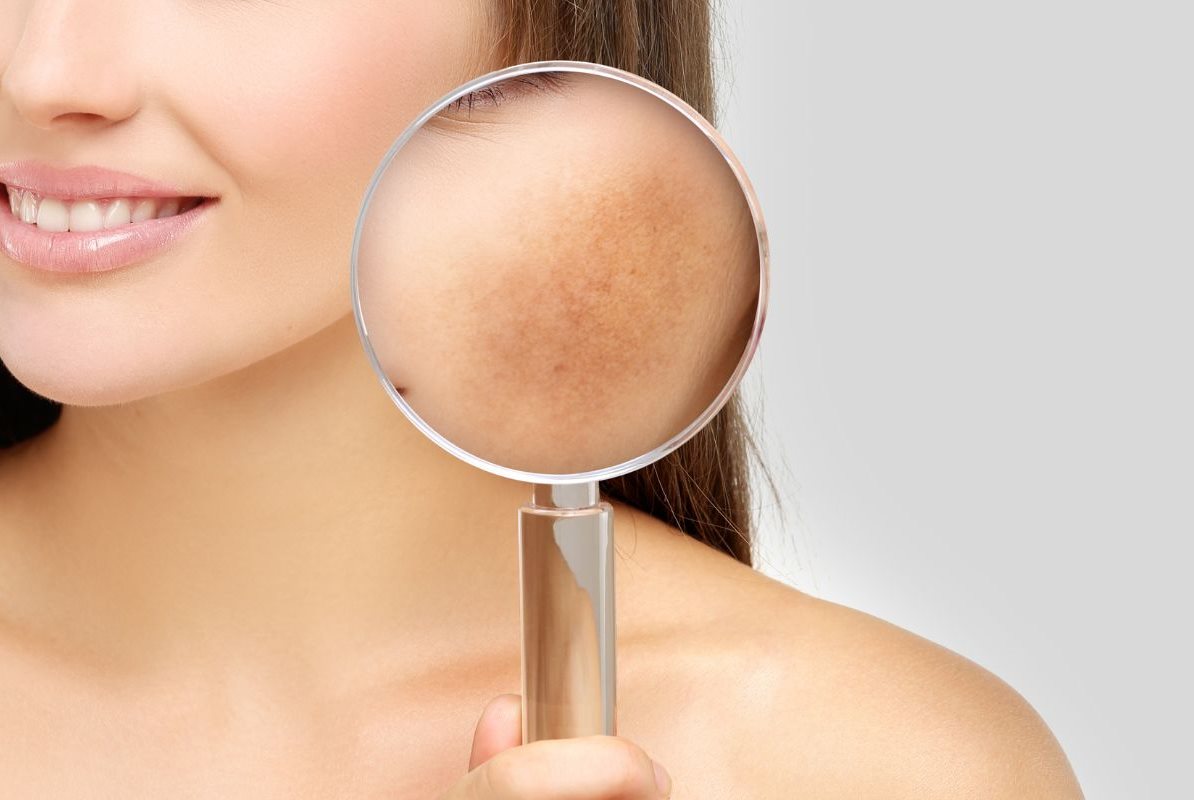 ฝ้าฮอร์โมน