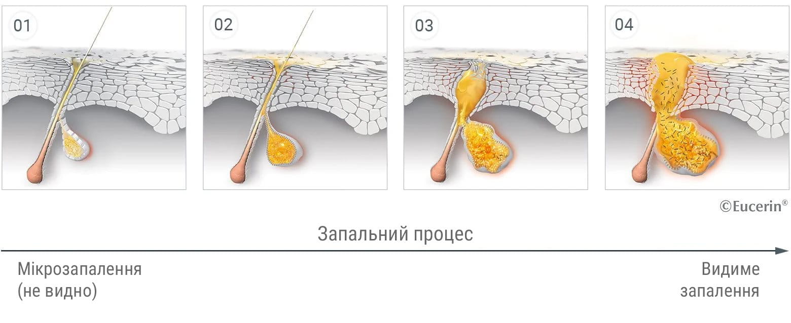 Виникнення акне та висипань