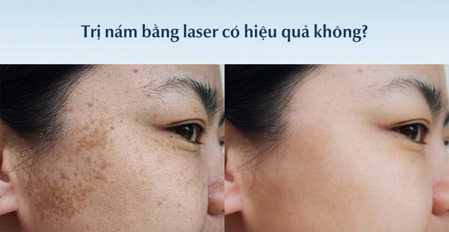 Bắn laser trị nám có hiệu quả không?