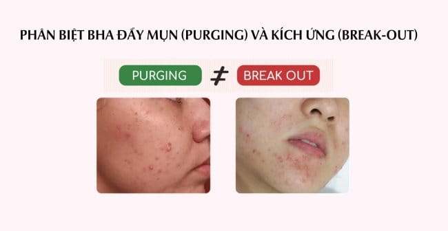 Phân biệt BHA đẩy mụn (Purging) và kích ứng (Break-out)