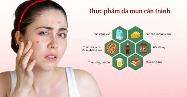 Những thực phẩm không nên ăn khi bị mụn trứng cá