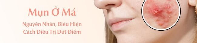 bị mụn ở má