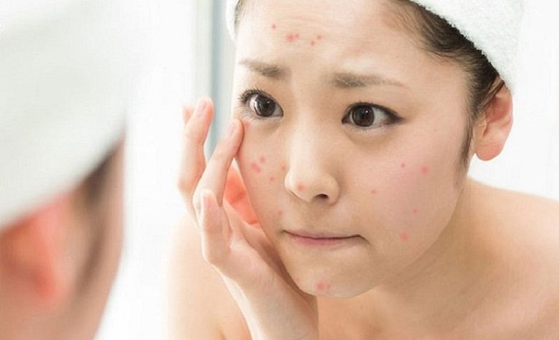 Cách skincare cho da mụn tuổi dậy thì: Bí quyết chăm sóc da hiệu quả