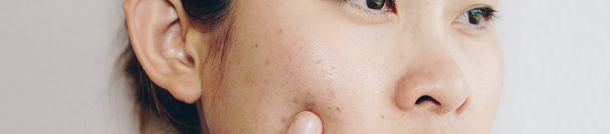 các bước skincare cho da mụn tuổi dậy thì hiệu quả