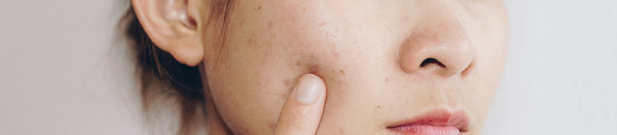 các bước skincare cho da mụn tuổi dậy thì hiệu quả