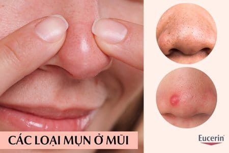 Các loại mụn ở mũi: Nguyên nhân và cách điều trị hiệu quả