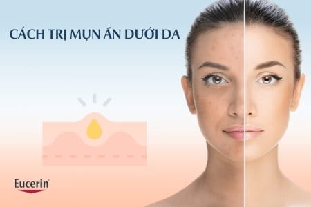 Cách trị mụn ẩn dưới da