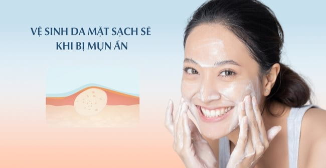 Vệ sinh da mụn ẩn sạch sẽ, đúng cách