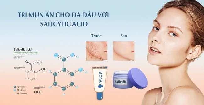Trị mụn ẩn cho da dầu với Salicylic Acid