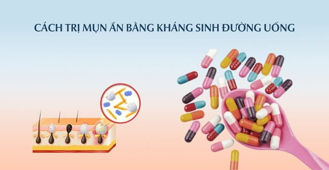 Cách trị mụn ẩn bằng kháng sinh đường uống