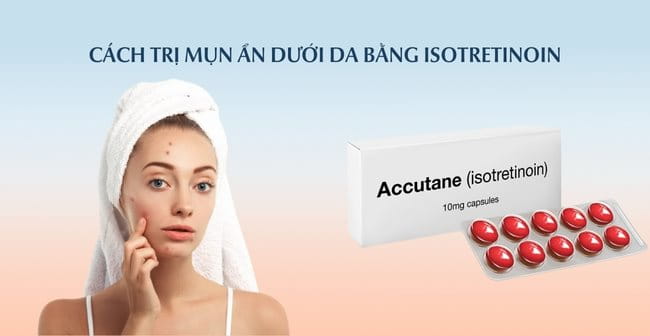 Cách trị mụn ẩn bằng Isotretinoin