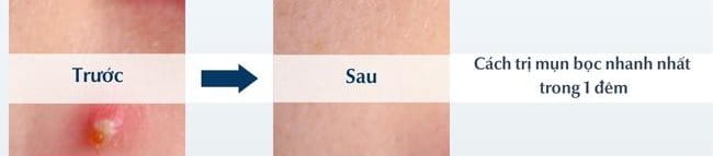 Cách trị mụn bọc nhanh nhất trong 1 đêm hiệu quả, an toàn