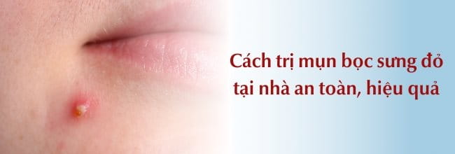 Cách trị mụn bọc sưng đỏ tại nhà an toàn, hiệu quả