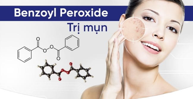 Cách trị mụn đầu đen bằng Benzoyl Peroxide