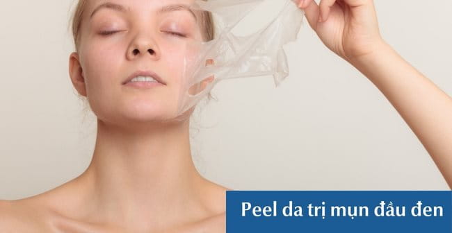 Peel da trị mụn đầu đen