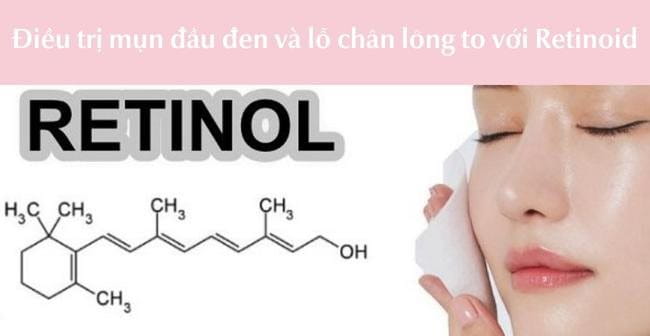 Cách trị mụn đầu đen và lỗ chân lông to bằng Retinoid