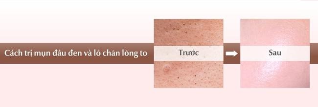 Cách trị mụn đầu đen và lỗ chân lông to đơn giản tại nhà