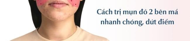 Cách trị mụn đỏ 2 bên má hiệu quả nhanh chóng