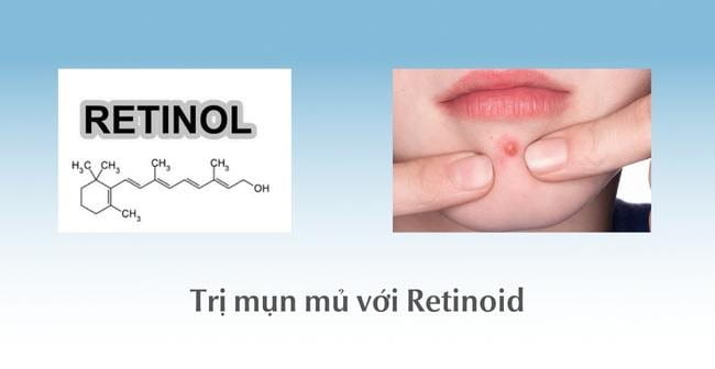 Cách trị mụn mủ với Retinoid