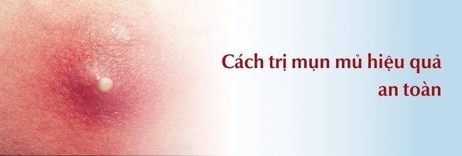 cách trị mụn mủ an toàn và hiệu quả