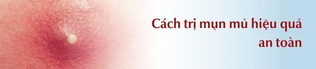 cách trị mụn mủ an toàn và hiệu quả