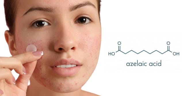 Hết mụn dậy thì với Azelaic Acid