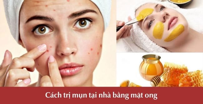 Cách trị mụn tại nhà cấp tốc bằng mật ong