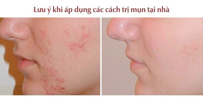 Một số lưu ý khi áp dụng các cách trị mụn tại nhà