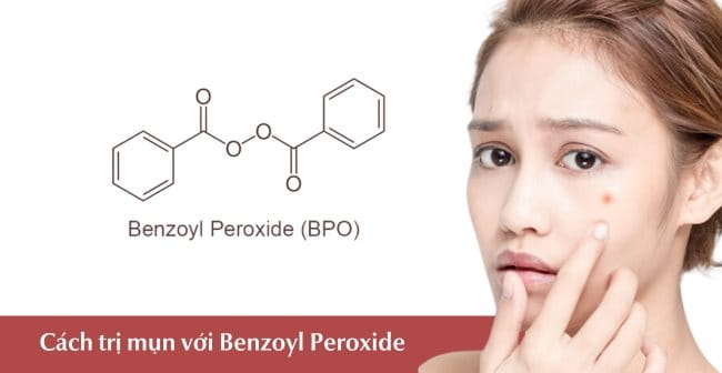 Cách trị mụn cấp tốc với Benzoyl Peroxide