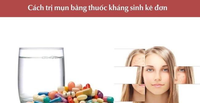 Trị mụn bằng các loại thuốc kháng sinh