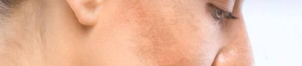 cách trị nám lâu năm