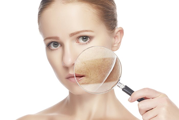 cách trị nám tại nhà