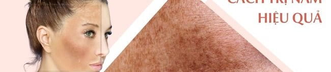 cách trị nám da tốt nhất hiện nay