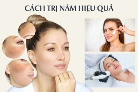 Cách trị nám hiệu quả