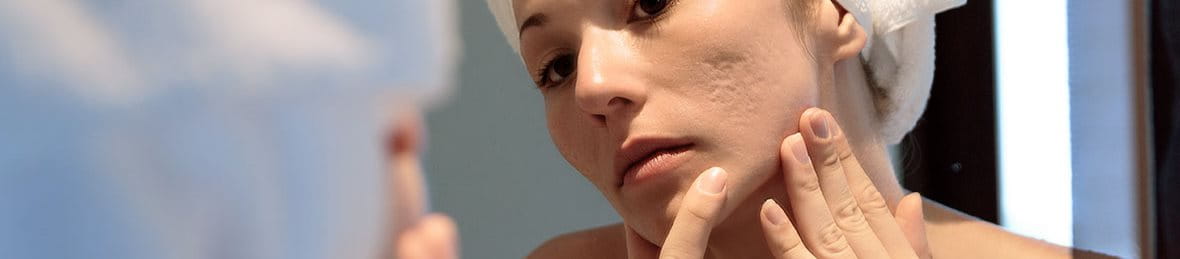 cách trị sẹo mụn