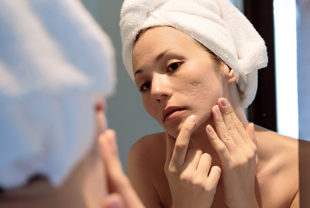 cách trị sẹo mụn