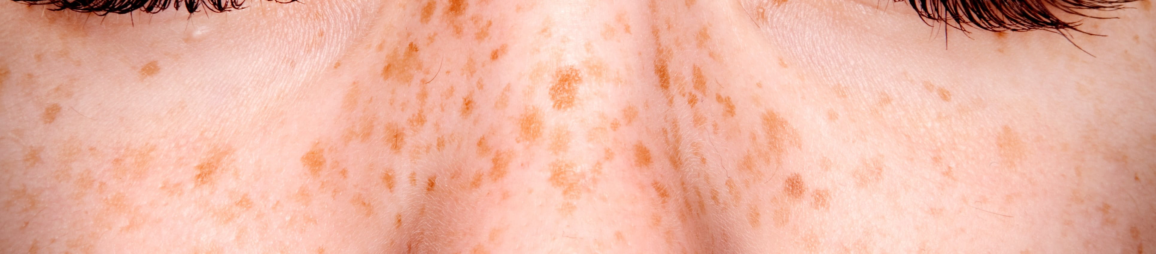 cách trị tàn nhang