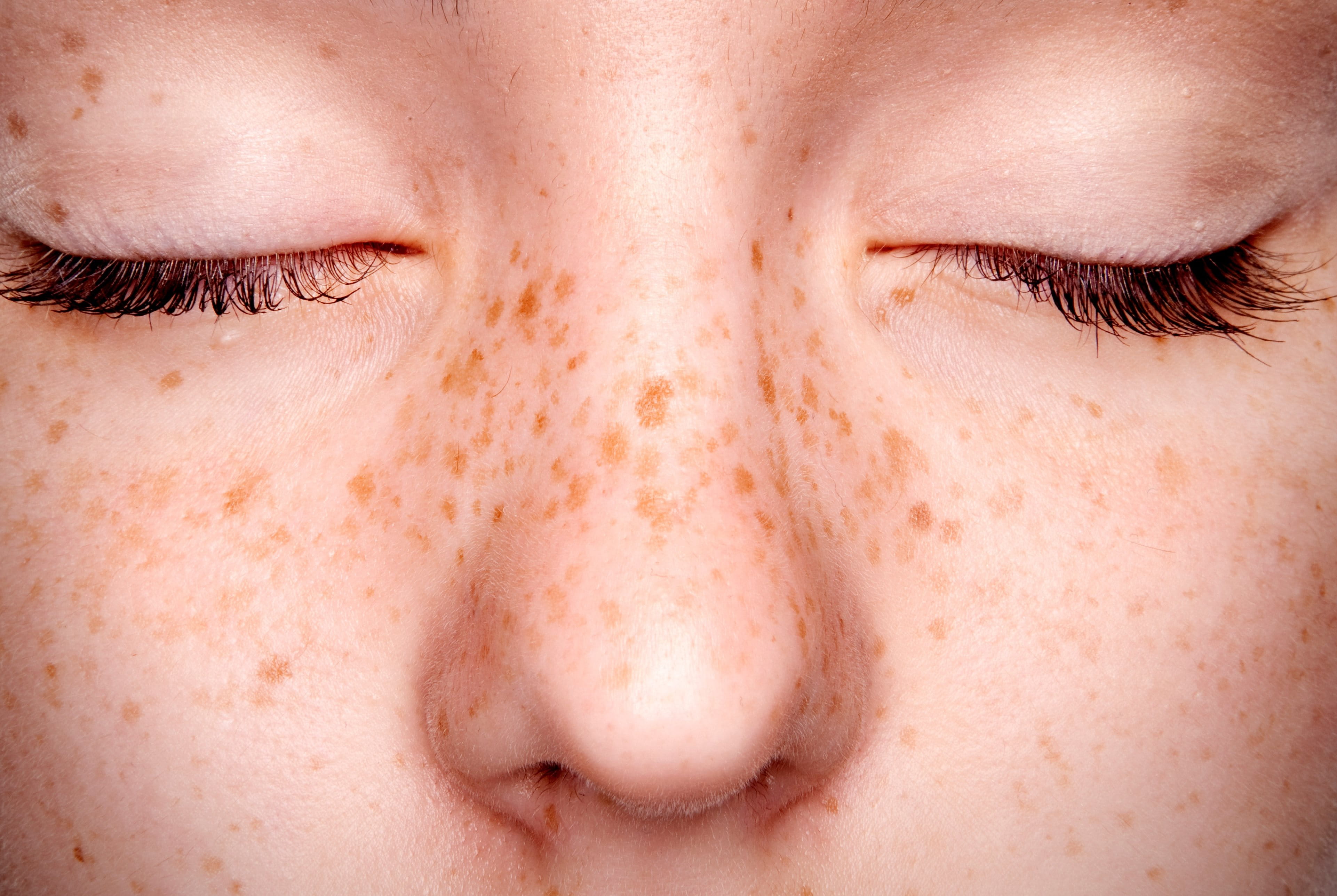 cách trị tàn nhang