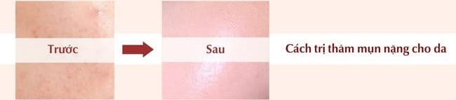 Cách trị thâm mụn nặng hiệu quả